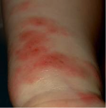 Se è possibile trattare il quarzo di psoriasi